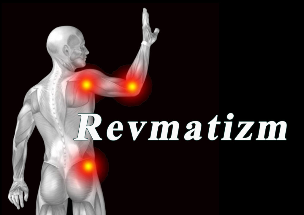 Revmatizm 2