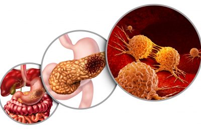 Pancreas,Cancer,Anatomy,Diagram,And,Pancreatic,Malignant,Tumor,Concept,As