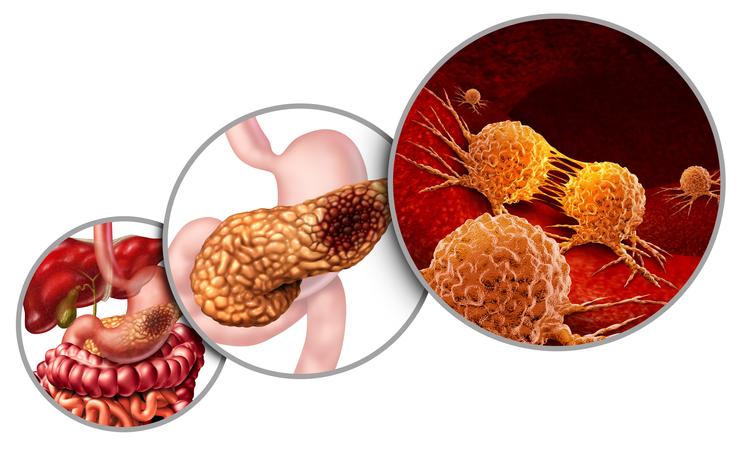 Pancreas,Cancer,Anatomy,Diagram,And,Pancreatic,Malignant,Tumor,Concept,As
